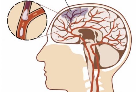 Accidente Cerebrovascular Accidente Cerebrovascular