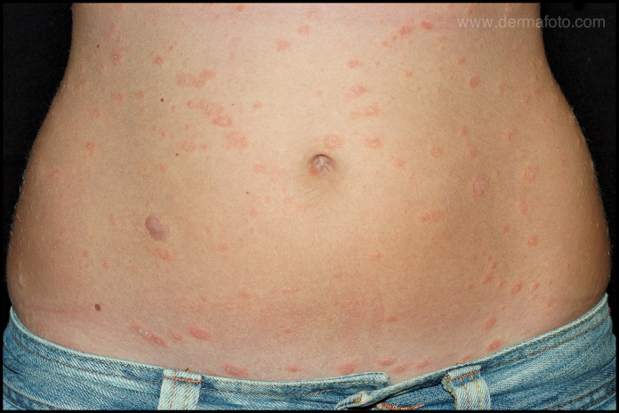 psoriasis