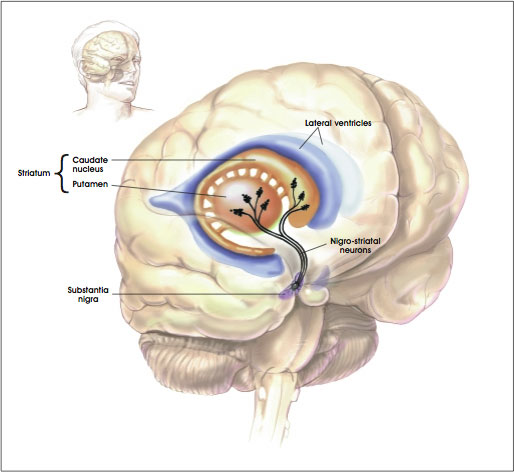 parkinsonsdisease