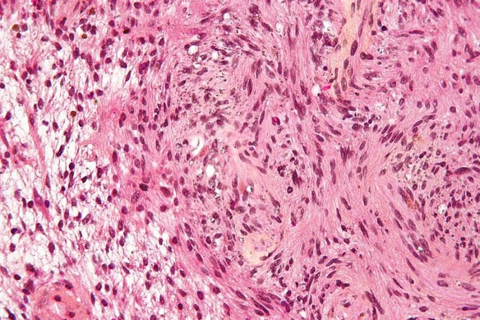 800px-Schwannoma_-_Antoni_A_and_B_-_very_high_mag