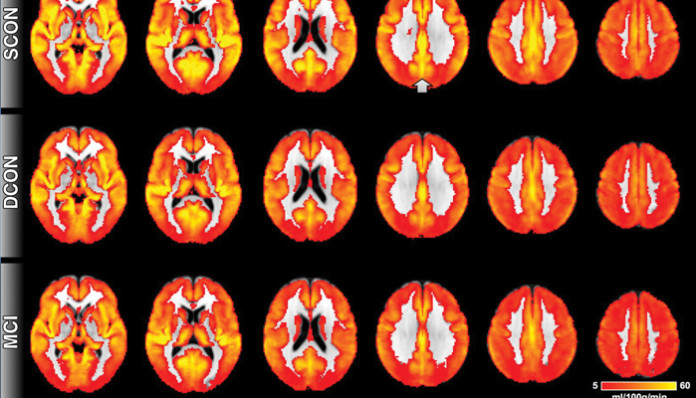 alzheimer