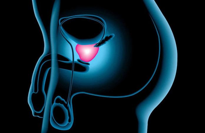 cancer-prostata