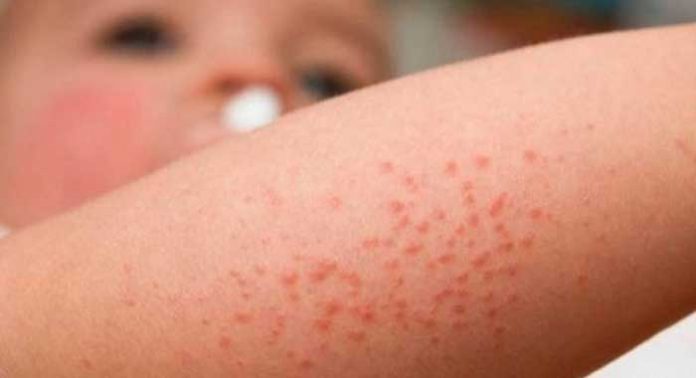 dermatitis-atopica