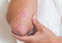 Cómo prevenir la propagación de la psoriasis