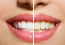 Remedios caseros para deshacerse de los dientes amarillos