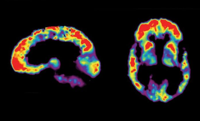 alzheimer